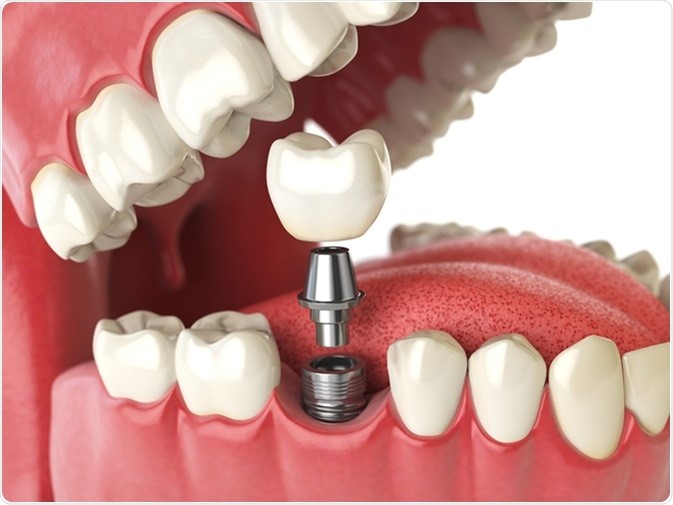 Sunt implanturile dentare potrivite pentru tine?